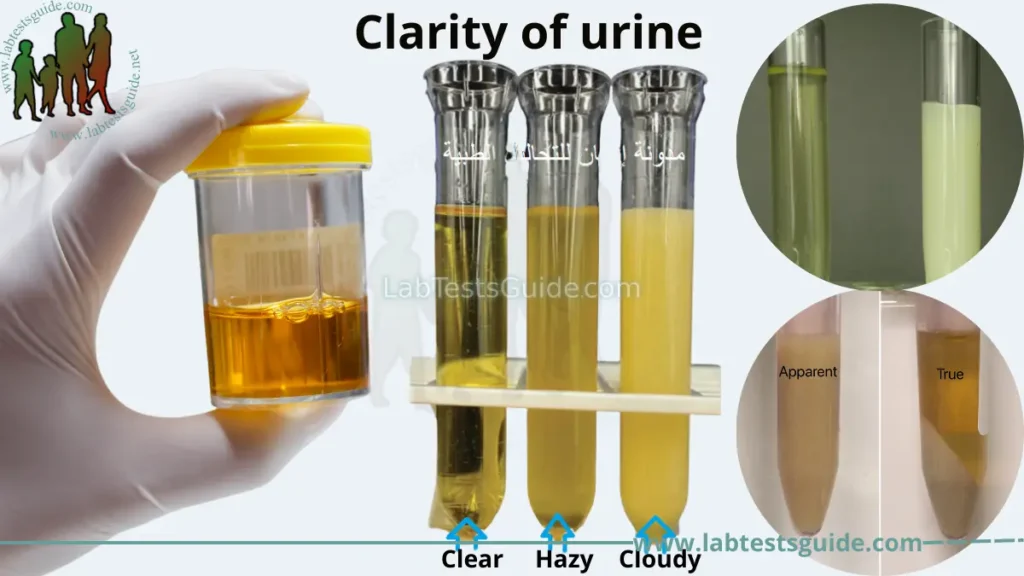 Understanding Cloudiness In Urine Causes Symptoms And Treatment